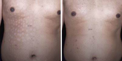 Tratamento de hipocromias com laser não ablativo ProDeep®