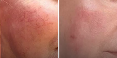 Lesões vasculares e estímulo de colágeno com IPL-Sq®