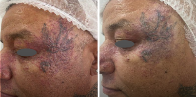 Tratamento de malformação vascular em face com IPL-Sq®