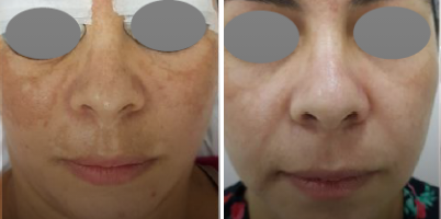 Tratamento de melasma com LASER Q-Switched e associações