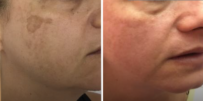 Tratamento de melasma e melanoses solares na face com LASER Q-Switched
