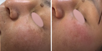 Tratamento de melasma facial com IPL-Sq®