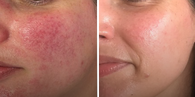 Tratamento de rosácea com LASER micropulsado de 1064nm - DYNAMICS®