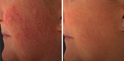 Tratamento de telangiectasias faciais