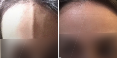 Tratamento de veia frontal com LASER Nd:YAG de pulso longo