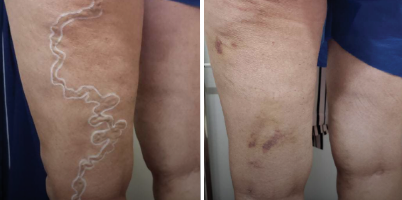 Veia varicosa em membro inferior com Nd:YAG de pulso longo e esclerosante