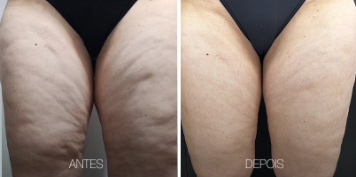 Uso dos lasers 1064 nm e 2940 nm para tratamento minimamente invasivo do Lipedema