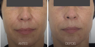 ZYE ALX® 755 nm no rejuvenescimento (clareamento + toning)