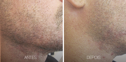 ZYE ALX® 755 nm no tratamento da Pseudofolliculitis Barbae