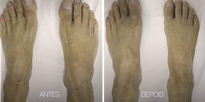 ZYE ALX® 755 nm no tratamento da dermatite ocre