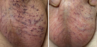 Tratamento de angioqueratoma escrotal com laser Nd:YAG 1.064 nm