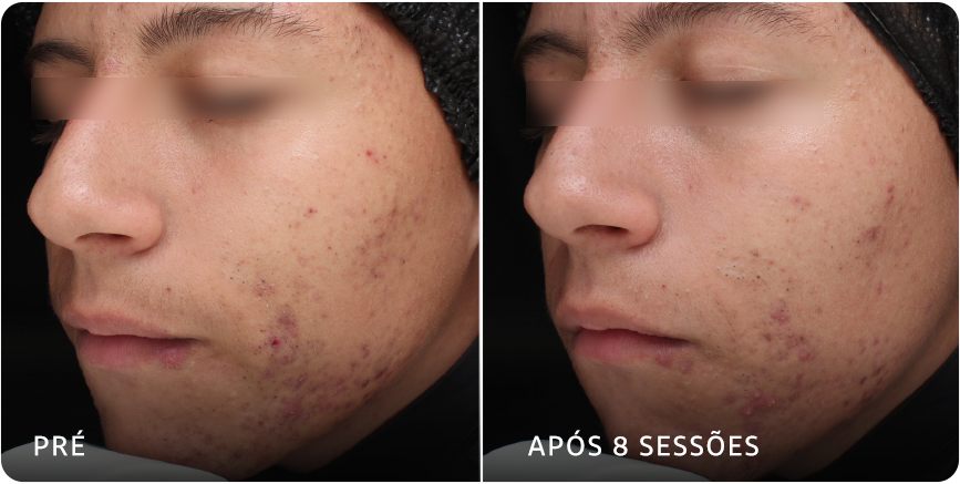 Caso clínico de acne ativa