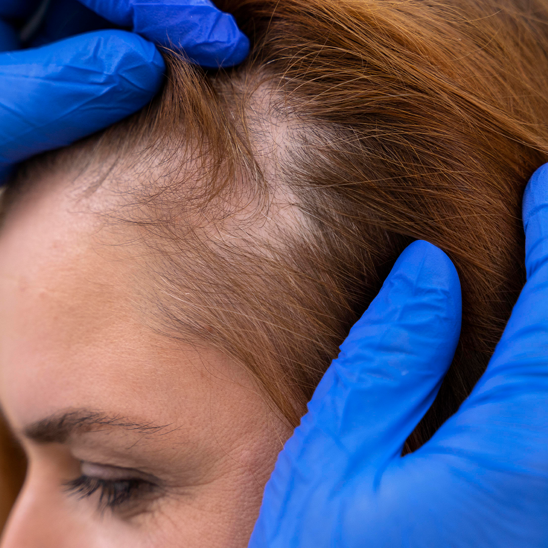Alopecia