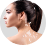 Vitiligo